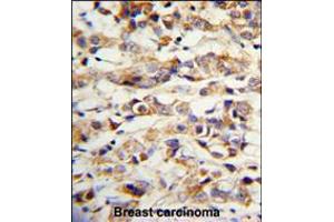 Formalin-fixed and paraffin-embedded human breast carcinoma with KRT14 Antibody , which was peroxidase-conjugated to the secondary antibody, followed by DAB staining. (KRT14 antibody  (AA 276-303))