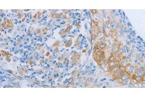Immunohistochemistry of paraffin-embedded Human cervical cancer tissue using ADRB3 Polyclonal Antibody at dilution 1:60 (ADRB3 antibody)