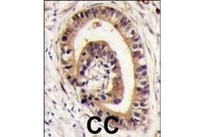 Formalin-fixed and paraffin-embedded human colon carcinoma tissue reacted with PIST antibody (C-term), which was peroxidase-conjugated to the secondary antibody, followed by DAB staining. (GOPC antibody  (C-Term))