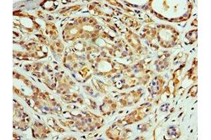 Immunohistochemistry of paraffin-embedded human breast cancer using ABIN7148496 at dilution of 1:100 (COPS4 antibody  (AA 1-310))