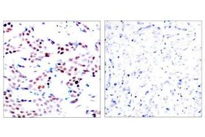 Immunohistochemical analysis of paraffin-embedded human breast carcinoma tissue using c-Jun(Phospho-Thr91) Antibody(left) or the same antibody preincubated with blocking peptide(right). (C-JUN antibody  (pThr91))