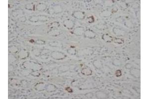 Immunohistochemical analysis of paraffin-embedded human carcinoma ventriculi sections, staining STAT1 in cytoplasm, DAB chromogeniic reaction (STAT1 antibody  (C-Term))