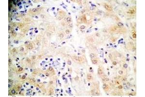 Human hepatocellular carcinoma tissue was stained by Rabbit Anti-FGF-21 (26-47) (H) (FGF21 antibody  (AA 26-47))