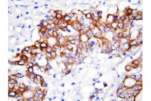 Anti-GCLC antibody, IHC(P) IHC(P): Human Rectal Cancer Tissue (GCLC antibody  (N-Term))