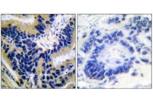 Immunohistochemical analysis of paraffin-embedded human lung carcinoma tissue, using Caspase 3 (cleaved-Asp175) antibody. (Caspase 3 antibody  (Cleaved-Asp175))