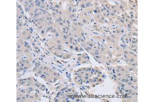 Immunohistochemistry of Human lung cancer using ABLIM1 Polyclonal Antibody at dilution of 1:30 (ABLIM1 antibody)