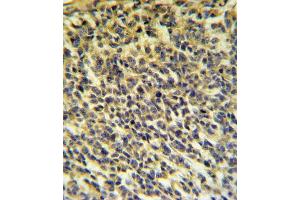PLA2G6 Antibody (Center) (ABIN653895 and ABIN2843138) IHC analysis in formalin fixed and paraffin embedded testis carcinoma followed by peroxidase conjugation of the secondary antibody and DAB staining. (PLA2G6 antibody  (AA 551-580))