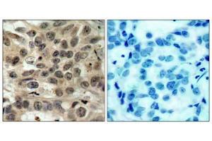 Immunohistochemical analysis of paraffin-embedded human breast carcinoma tissue, using cdc25C (Ab-216) antibody (E021145). (CDC25C antibody)