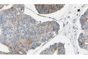 ABIN6276417 at 1/100 staining Human prostate tissue by IHC-P. (JUP antibody  (C-Term))