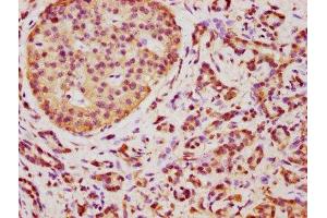 IHC image of ABIN7173067 diluted at 1:350 and staining in paraffin-embedded human pancreatic cancer performed on a Leica BondTM system. (TMEM14A antibody  (AA 45-78))
