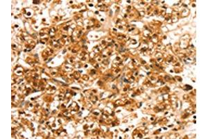 The image on the left is immunohistochemistry of paraffin-embedded Human prostate cancer tissue using ABIN7192494(SLC44A2 Antibody) at dilution 1/20, on the right is treated with synthetic peptide. (SLC44A2 antibody)