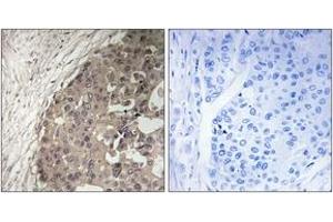 Immunohistochemistry analysis of paraffin-embedded human breast carcinoma tissue, using CSGALNACT1 Antibody.