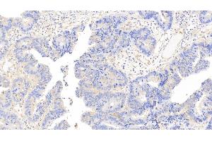 Detection of CAM in Human Colorectal cancer Tissue using Polyclonal Antibody to Calmodulin (CAM) (Calmodulin 1 antibody  (AA 2-149))