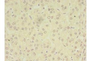 Immunohistochemistry of paraffin-embedded human liver cancer using ABIN7162969 at dilution of 1:100 (PEX11B antibody  (AA 9-228))