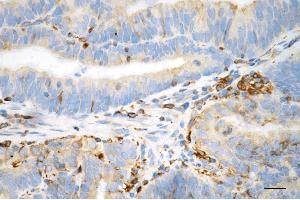 Immunohistochemistry was performed on paraffin-embedded human endometrial carcinoma using phospho-vimentin (Ser72) antibody (ABIN7800835), 1:100).