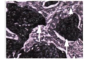 Immunohistochemical staining of paraffin embedded esophageal tumors using Act-MMP9 antibody . (MMP 9 antibody  (N-Term))