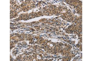 Immunohistochemistry of Human gastric cancer using IFNGR2 Polyclonal Antibody at dilution of 1:40 (IFNGR2 antibody)