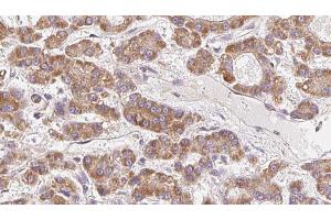 ABIN6272699 at 1/100 staining Human liver cancer tissue by IHC-P. (OR10H5 antibody  (C-Term))