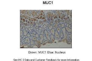 Sample Type :  Human stomach  Primary Antibody Dilution :  1:200  Secondary Antibody :  Anti-rabbit-HRP  Secondary Antibody Dilution :  1:1000  Color/Signal Descriptions :  Brown: MUC1 Blue: Nucleus  Gene Name :  MUC1  Submitted by :  Dr. (MUC1 antibody  (Middle Region))