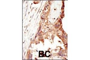 Formalin-fixed and paraffin-embedded human cancer tissue reacted with the primary antibody, which was peroxidase-conjugated to the secondary antibody, followed by DAB staining. (PRDM14 antibody  (N-Term))