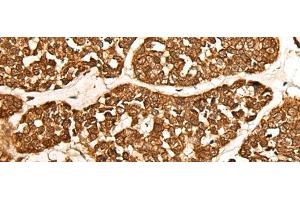 Immunohistochemistry of paraffin-embedded Human esophagus cancer tissue using CALML6 Polyclonal Antibody at dilution of 1:55(x200) (CALML6 antibody)