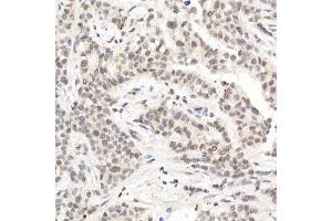 Immunohistochemistry of paraffin-embedded human breast cancer using [KO Validated] L3MBTL3 Rabbit pAb (ABIN6132145, ABIN6143061, ABIN6143062 and ABIN6223119) at dilution of 1:50 (40x lens). (L3MBTL3 antibody  (AA 1-230))