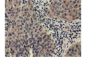 Immunohistochemical staining of paraffin-embedded Carcinoma of Human bladder tissue using anti-CBWD1 mouse monoclonal antibody. (CBWD1 antibody)