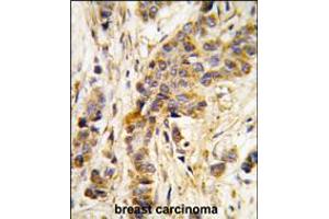 Formalin-fixed and paraffin-embedded human breast carcinoma tissue reacted with IARS2 antibody , which was peroxidase-conjugated to the secondary antibody, followed by DAB staining.