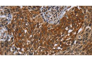 Immunohistochemistry of paraffin-embedded Human cervical cancer tissue using UHRF2 Polyclonal Antibody at dilution 1:40 (UHRF2 antibody)