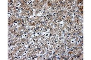 Immunohistochemical staining of paraffin-embedded Carcinoma of liver tissue using anti-SIL1 mouse monoclonal antibody. (SIL1 antibody)