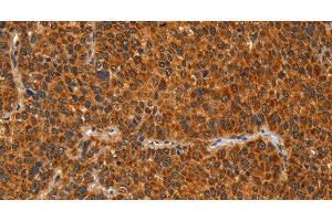 Immunohistochemistry of paraffin-embedded Human liver cancer tissue using IKZF3 Polyclonal Antibody at dilution 1:60