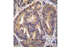 Immunohistochemistry analysis in formalin fixed and paraffin embedded human prostate carcinoma reacted with GTF2H2C Antibody (C-term) followed by peroxidase conjugation of the secondary antibody and DAB staining. (GTF2H2C antibody  (C-Term))