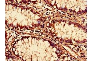 Immunohistochemistry of paraffin-embedded human colon cancer using ABIN7170624 at dilution of 1:100 (Pre-mRNA Branch Site Protein p14 (SF3B14) (AA 1-125) antibody)