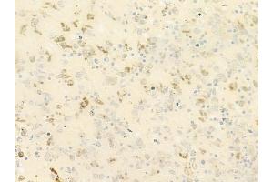 ABIN6264416 and ABIN6279652 at 1/100 staining human melanoma by IHC-P. (PREX1 antibody  (Internal Region))