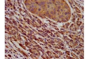 IHC image of ABIN7163609 diluted at 1:600 and staining in paraffin-embedded human pancreatic cancer performed on a Leica BondTM system. (PAFAH1B3 antibody  (AA 103-187))