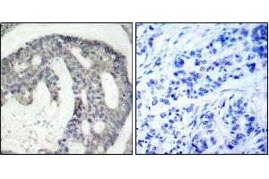 Immunohistochemistry of paraffin-embedded human breast carcinoma using Phospho-NOS3-S1177 antibody (ABIN2988223). (ENOS antibody  (pSer1177))