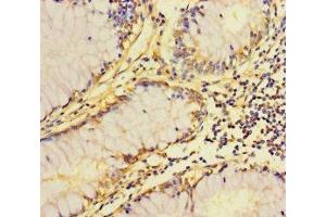 Immunohistochemistry of paraffin-embedded human colon cancer using ABIN7162535 at dilution of 1:100 (ZDHHC15 antibody  (AA 239-337))