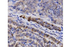 Immunohistochemistry of paraffin-embedded Human thyroid cancer using SNCG Polyclonal Antibody at dilution of 1:200 (40x lens). (SNCG antibody)