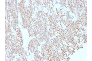 IHC testing of FFPE human lymphoma with Bcl6 antibody (clone BCL6/1527). (BCL6 antibody  (AA 256-389))
