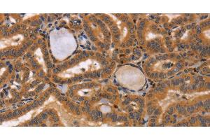 Immunohistochemistry of paraffin-embedded Human thyroid cancer tissue using CCL23 Polyclonal Antibody at dilution 1:50 (CCL23 antibody)