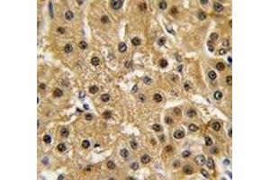 IHC analysis of FFPE human hepatocarcinoma tissue stained with c-Abl antibody (ABL1 antibody  (AA 741-769))
