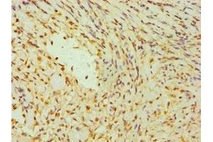 Immunohistochemistry of paraffin-embedded human breast cancer using ABIN7142266 at dilution of 1:100 (DAP3 antibody  (AA 159-398))