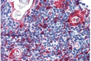 Human Thymus (formalin-fixed, paraffin-embedded) stained with KRT13 antibody ABIN364278 at 10 ug/ml followed by biotinylated anti-mouse IgG secondary antibody ABIN481714, alkaline phosphatase-streptavidin and chromogen. (Cytokeratin 13 antibody)