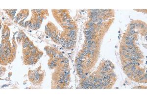 Immunohistochemistry of paraffin-embedded Human colon cancer tissue using PARD6A Polyclonal Antibody at dilution 1:60 (PARD6A antibody)