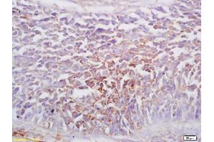 Formalin-fixed and paraffin embedded human lung carcinoma labeled with Rabbit Anti EphA1/Ephrina1/Ephrin A1 Receptor Polyclonal Antibody, Unconjugated (ABIN734108) at 1:200 followed by conjugation to the secondary antibody and DAB staining (Ephrin A1 antibody  (AA 101-205))
