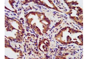 IHC image of ABIN7155861 diluted at 1:200 and staining in paraffin-embedded human lung cancer performed on a Leica BondTM system.