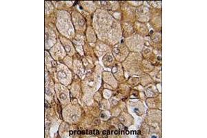 Formalin-fixed and paraffin-embedded human prostata carcinoma tissue reacted with CAMK1G (Center K226) , which was peroxidase-conjugated to the secondary antibody, followed by DAB staining. (CAMK1G antibody  (AA 211-241))