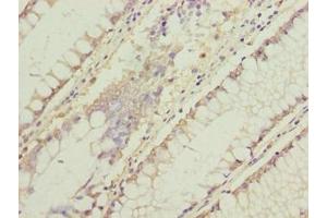Immunohistochemistry of paraffin-embedded human colon cancer using ABIN7174715 at dilution of 1:100 (C11orf53 antibody  (AA 13-236))
