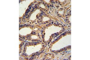 Formalin-fixed and paraffin-embedded human prostate carcinoma with NA Antibody (N-term), which was peroxidase-conjugated to the secondary antibody, followed by DAB staining. (NPPA antibody  (N-Term))