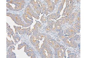 IHC analysis of IQGAP1 using anti-IQGAP1 antibody (ABIN6719262). (IQGAP1 antibody)